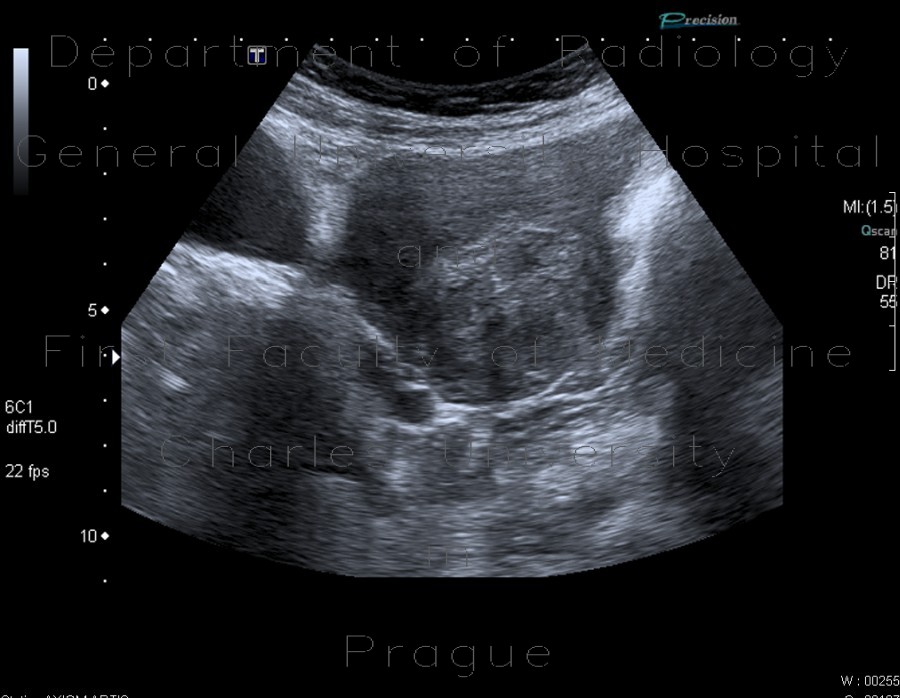 Radiology image - Fibroid of uterus, uterine fibroid: Abdomen, Gynecology: US - Ultrasound