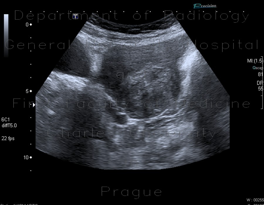 Fibroid of uterus, uterine fibroid