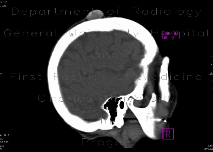 Radiology image - Fibroma, subcutaneous: Head and Neck, Soft tissue: CT - Computed tomography