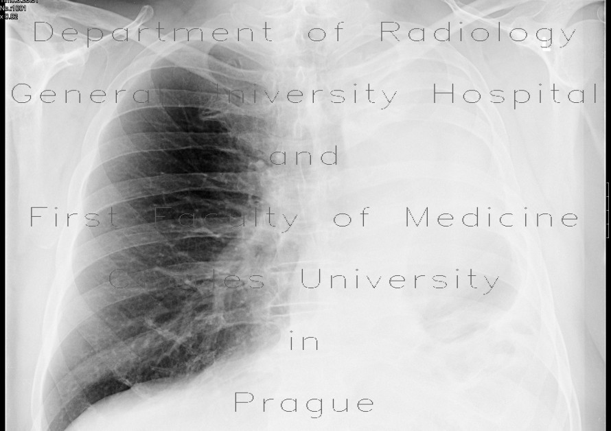 Fibrothorax after pneumonectomy