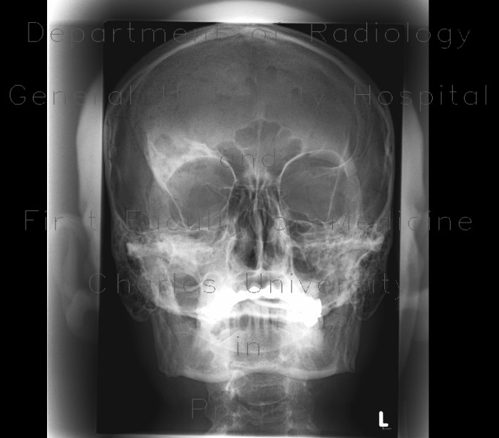 Fibrous dysplasia of frontal bone