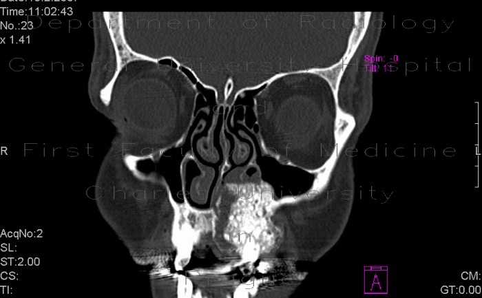 Radiology image - Fibrous dysplasia of maxilla: Head and Neck, Bone: CT - Computed tomography