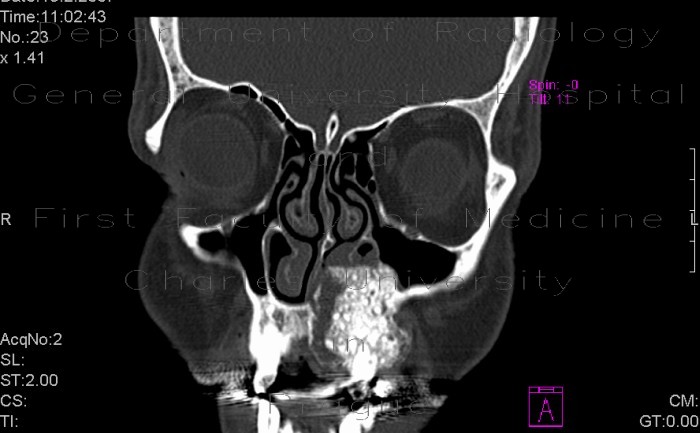 Fibrous dysplasia of maxilla