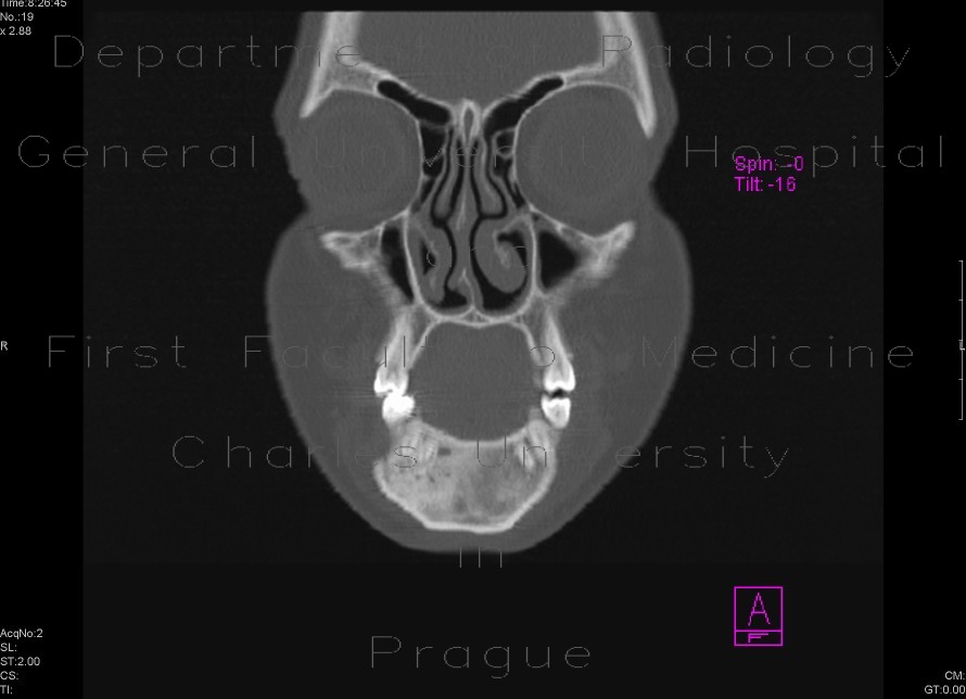 Radiology image - Fibrous dysplasia of the mandible: Head and Neck, Bone: CT - Computed tomography
