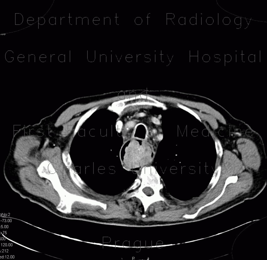 Fibrovascular polyp of oesophagus