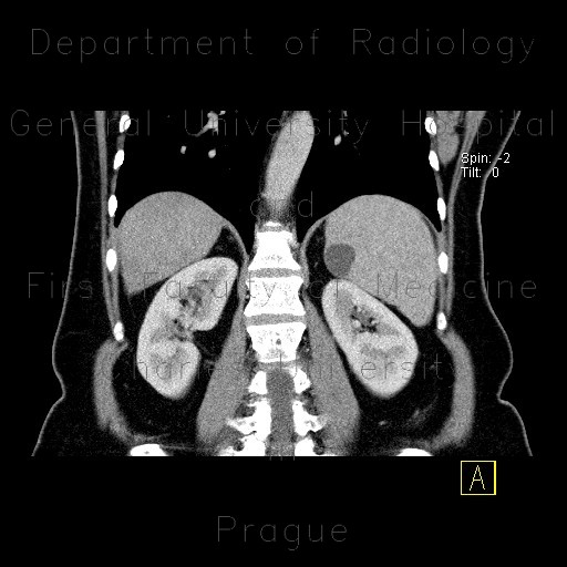 Radiology image - Fissural cyst of spleen: Abdomen, Lymphatic: CT - Computed tomography