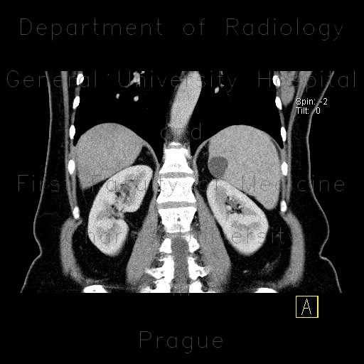 Fissural cyst of spleen