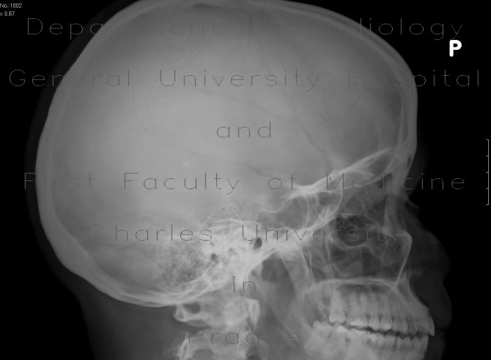 Fissure of frontal bone