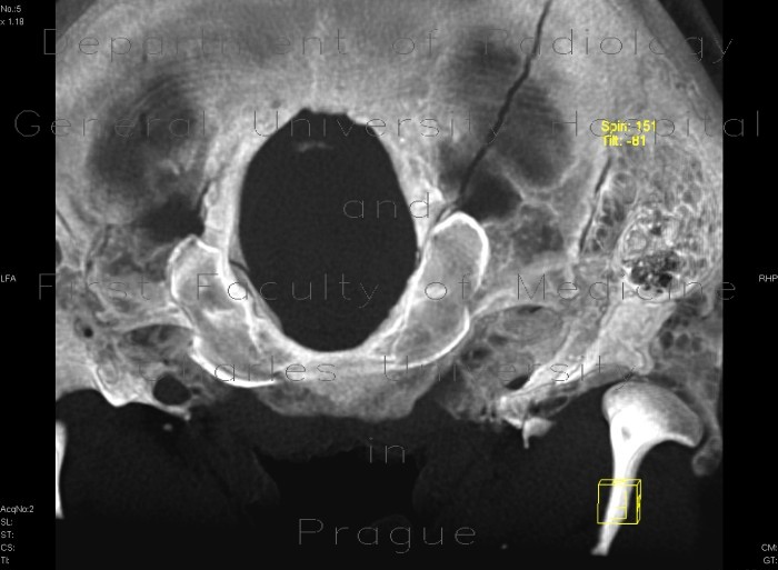 Radiology image - Fissure of occipital bone, terminating in foramen magnum: Spine and Axial, Bone: CT - Computed tomography