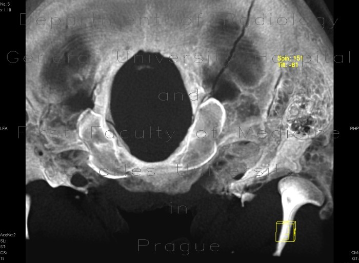 Fissure of occipital bone, terminating in foramen magnum