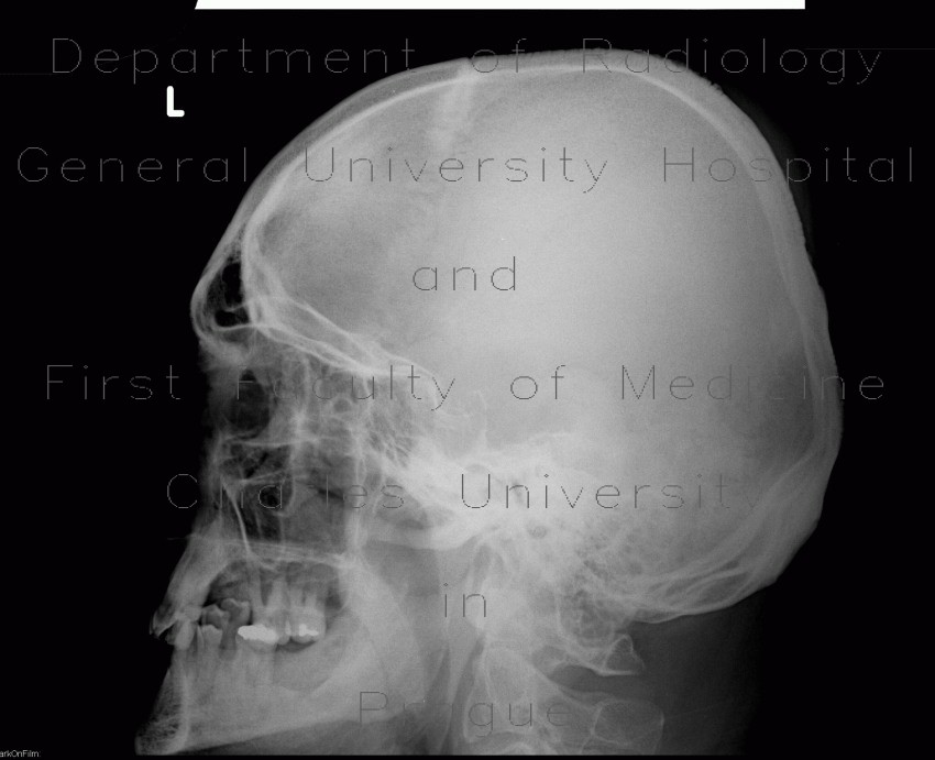 Fissure of skull, epidural hematoma