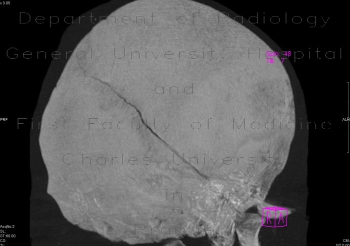 Fissure of skull, pneumocephalus, contusion