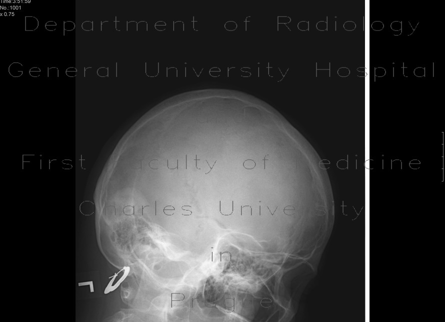Radiology image - Fissure of the skull, pneumocephalus: Brain, Head and Neck, Bone, Brain: X-ray - Plain radiograph