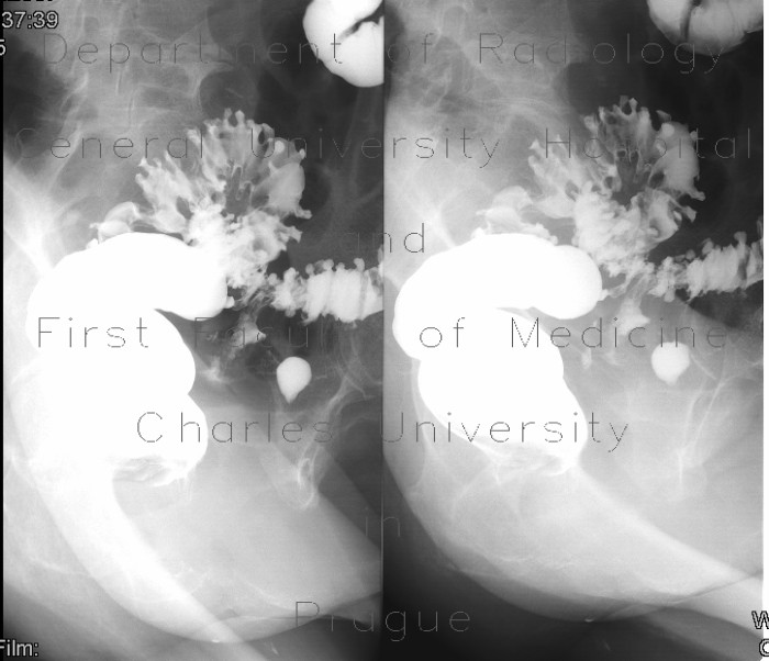 Radiology image - Fistula of sigmoid colon, diverticulosis, irrigography: Abdomen, Large bowel: RF - Fluoroscopy