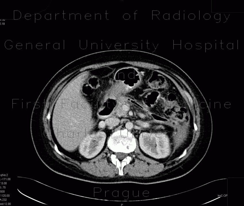 Fistula, retroperitoneal