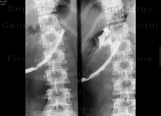 Radiology image - Fistulography of a cavity adjacent to pancreas: Abdomen, Pancreas: RF - Fluoroscopy