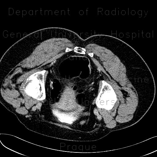 Flat lesion, colorectal carcinoma, sigmoid colon, CTC, CT colonography