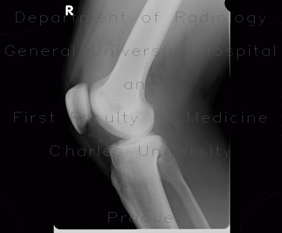 Fluid in suprapatellary recess on radiograph