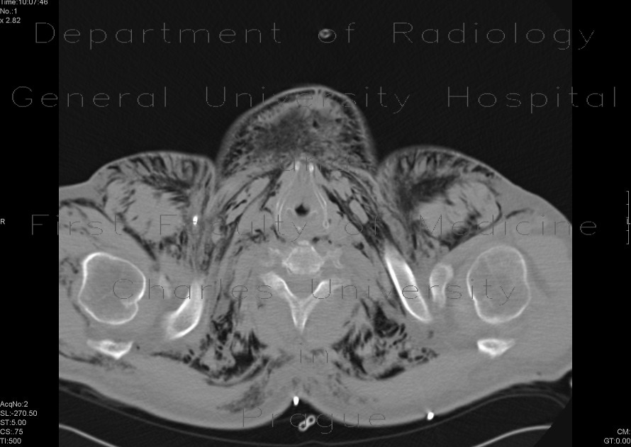 Radiology image - Fluidopneumothorax, pneumomediastinum, subcutaneous emphysema, muscular emphysema, pneumocolum: Thorax, Lung, Mediastinum and pleural cavity: CT - Computed tomography