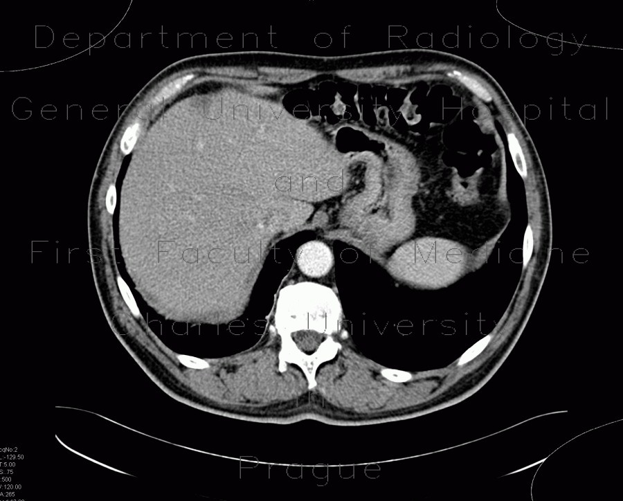 Radiology image - Focal hepatopathy, falciform ligament: Abdomen, Liver: CT - Computed tomography