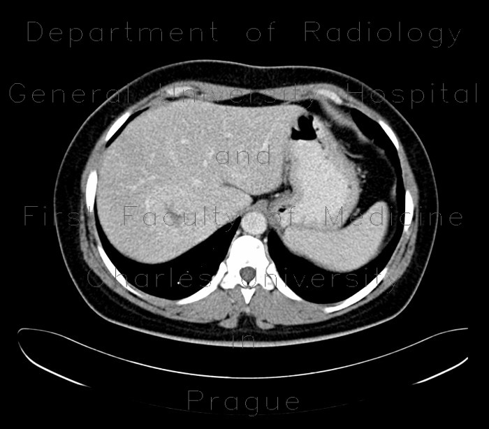 Radiology image - Focal nodular hyperplasia: Abdomen, Liver: CT - Computed tomography