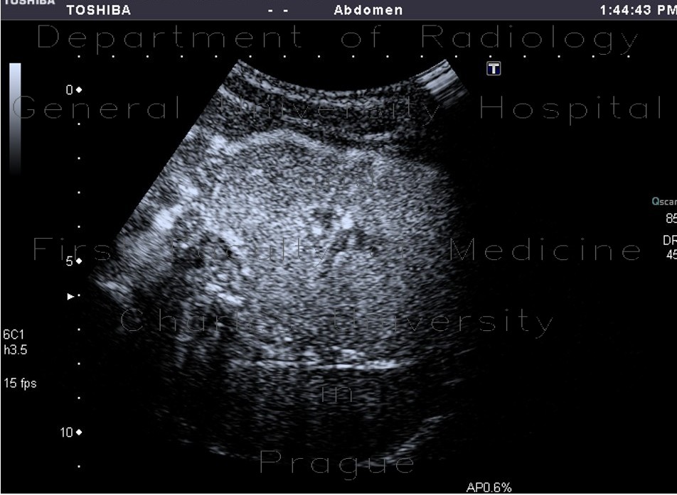 Focal nodular hyperplasia, CEUS