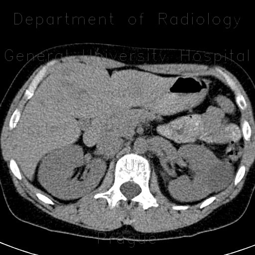 Radiology image - Focal nodular hyperplasia, FNH, flow rate of contrast: Abdomen, Liver: CT - Computed tomography