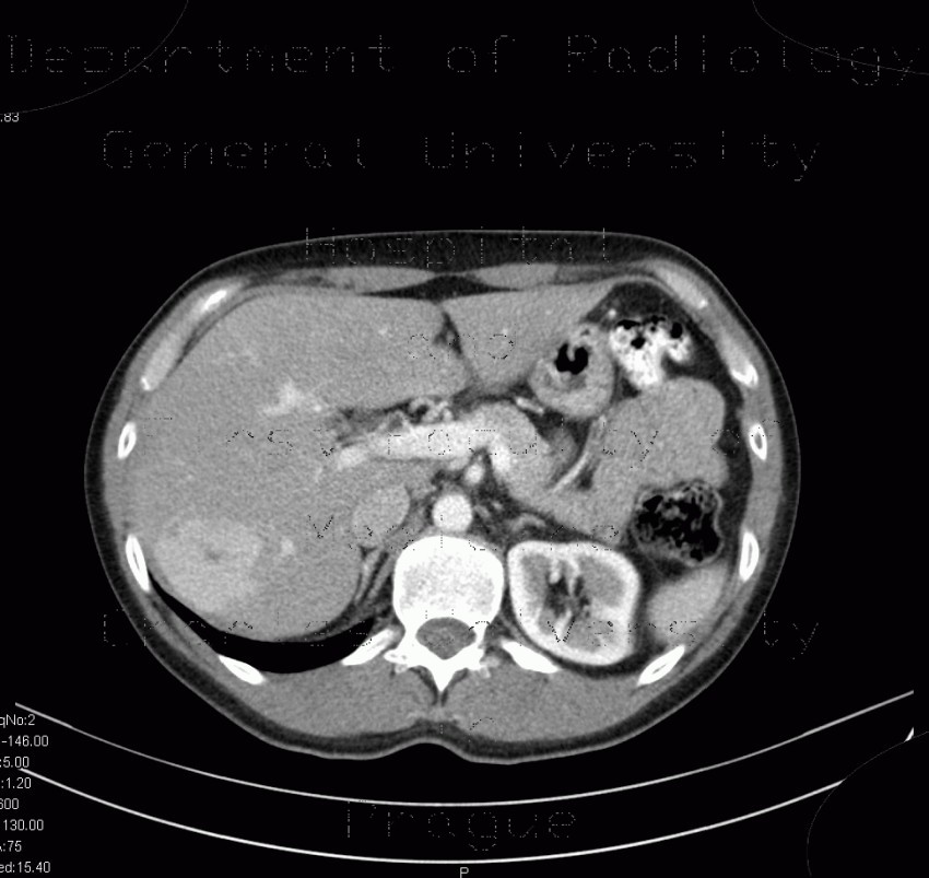 Radiology image - Focal nodular hyperplasia, liver: Abdomen, Liver: CT - Computed tomography