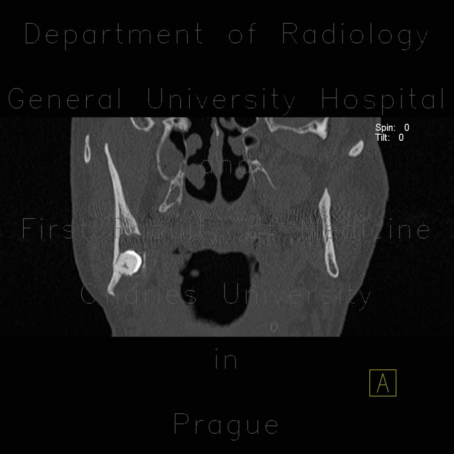 Radiology image - Follicular cyst, adamantinoma: Head and Neck, Oral cavity: CT - Computed tomography