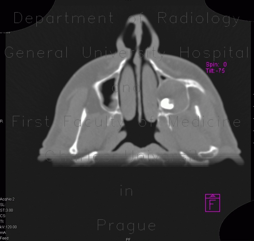 Follicular cyst in the maxillary sinus