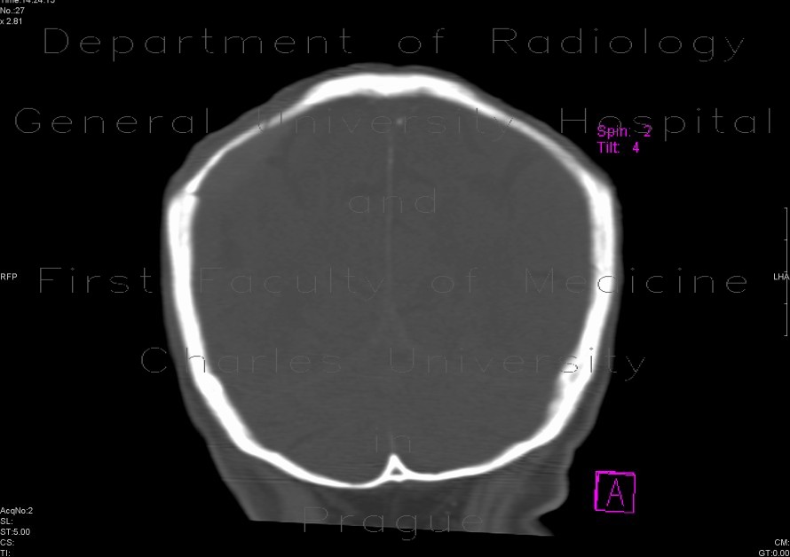 Radiology image - Foramina parietalia, skull fissure: Spine and Axial, Bone: CT - Computed tomography