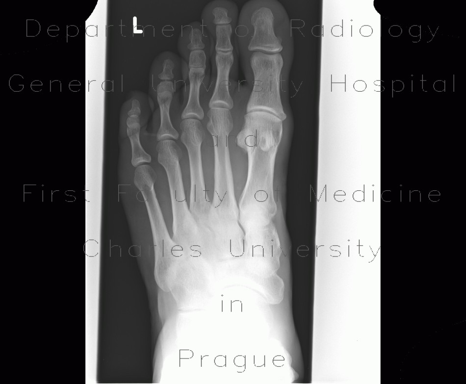 Foreign body in the foot, pipette