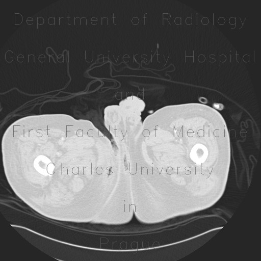 Fournier gangrene