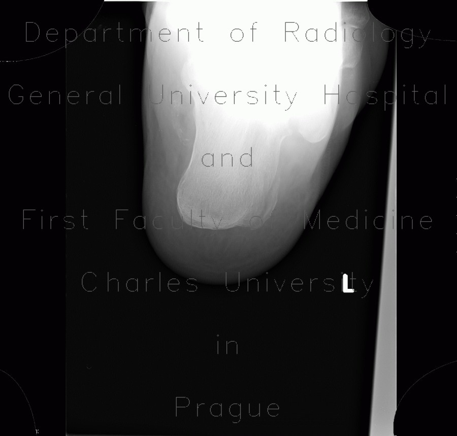 Fracture of calcaneus, atypical