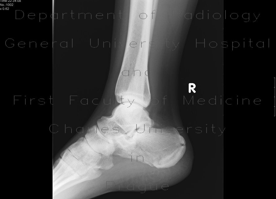 Fracture of calcaneus, comminuted