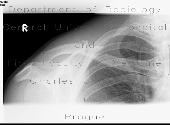 Fracture of collar bone, clavicle