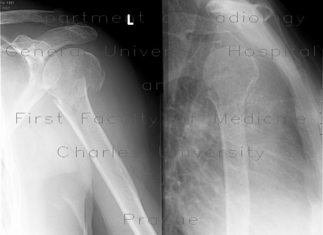 Radiology image - Fracture of colum chirurgicum of humerus: Extremity, Bone: X-ray - Plain radiograph