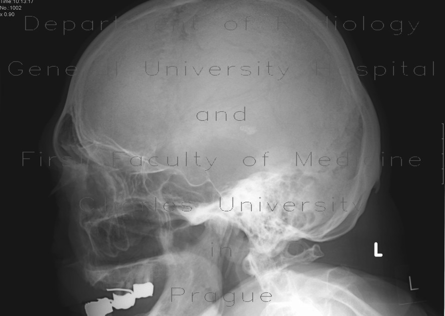 Fracture of dens axis