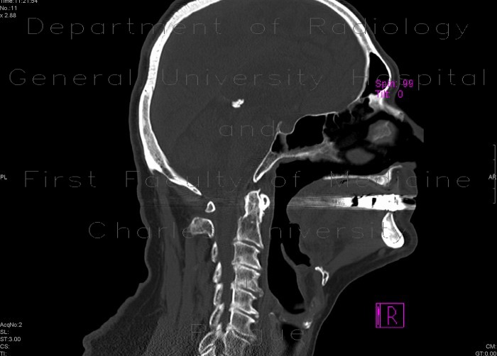 Fracture of dens axis