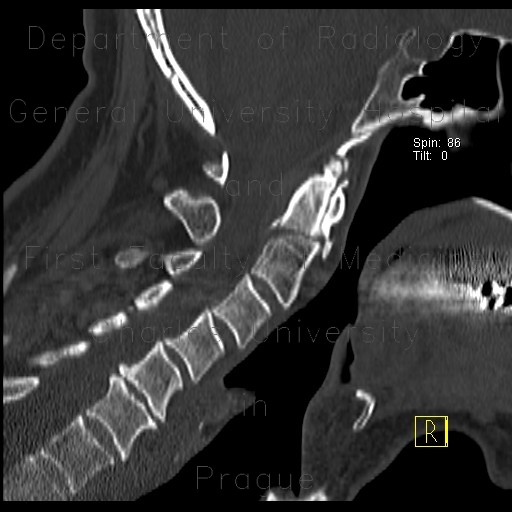 Radiology image - Fracture of dens axis: Spine and Axial, Bone: CT - Computed tomography