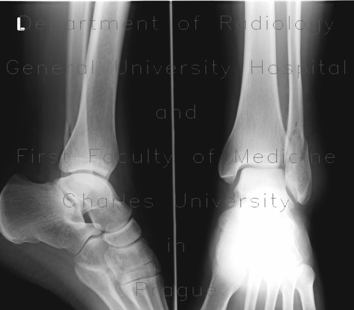 Fracture of fibular ankle, Weber B