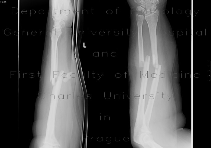 Radiology image - Fracture of forearm bones, ulna and radius: Extremity, Bone: X-ray - Plain radiograph