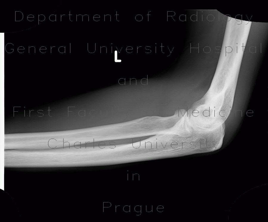 Fracture of head of radius, fat pad sign, sail sign