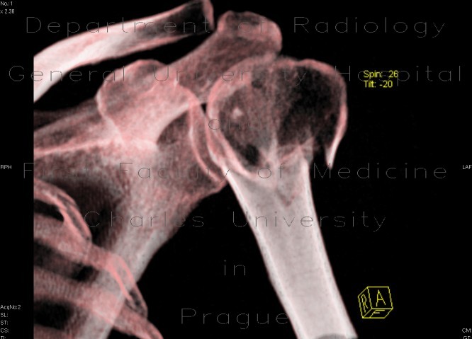 Fracture of humerus, comminuted