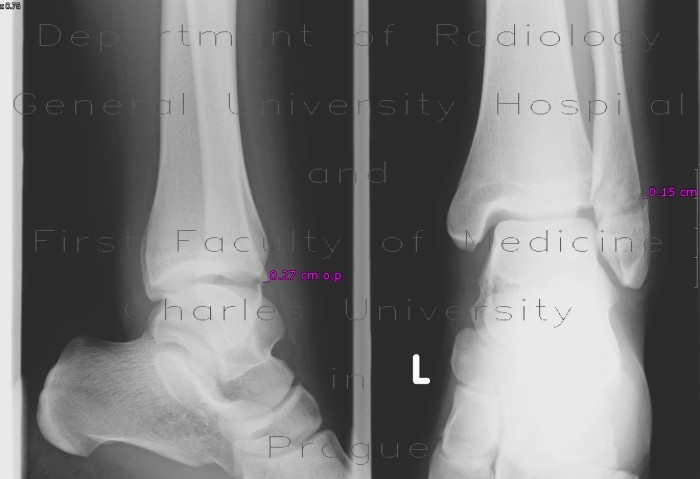 Fracture of lateral ankle, distal fibula, Weber B, subluxation of talus