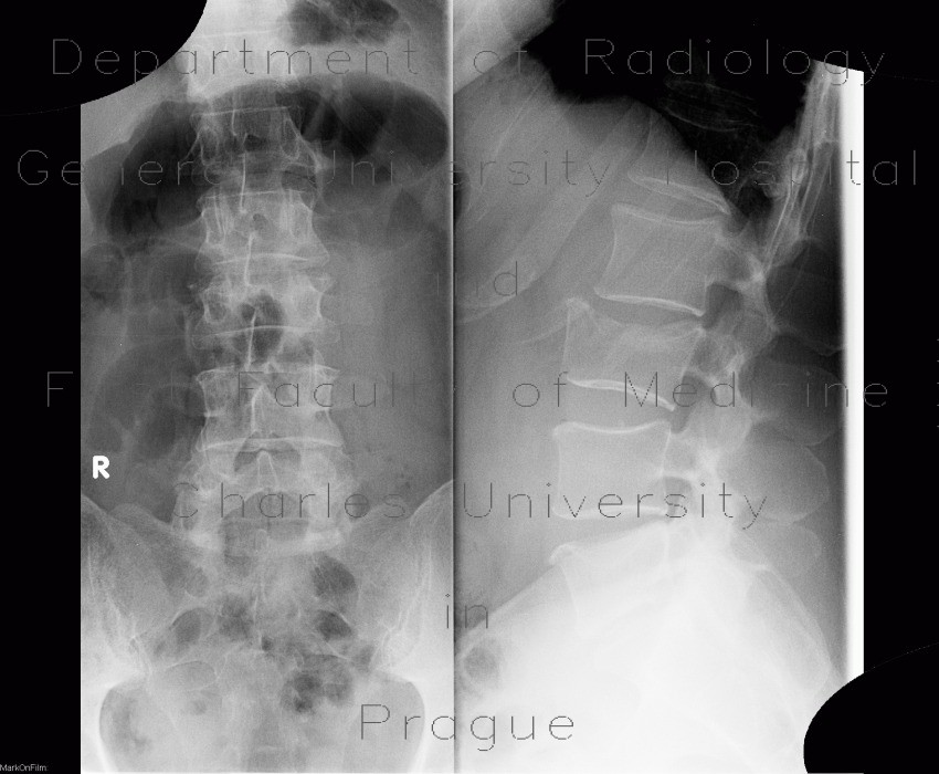 Radiology image - Fracture of lumbar vertebra, comminuted, burst fracture: Spine and Axial, Bone: X-ray - Plain radiograph