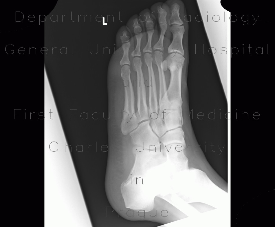 Fracture of metatarsal bone, subacute fracture