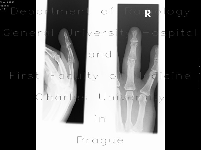 Fracture of middle phalanx