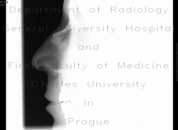 Fracture of nasal bones