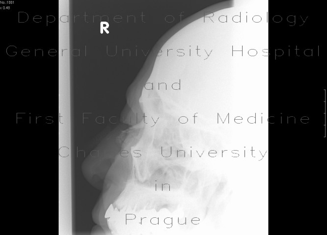 Fracture of nasal bones, comminuted
